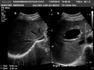 ภาพอัลตราซาวด์ถุงน้ำที่ตับ